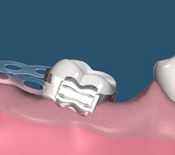 Implants, orthodontics or bridges