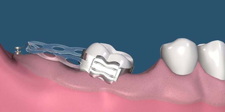 Implants, orthodontics or bridges