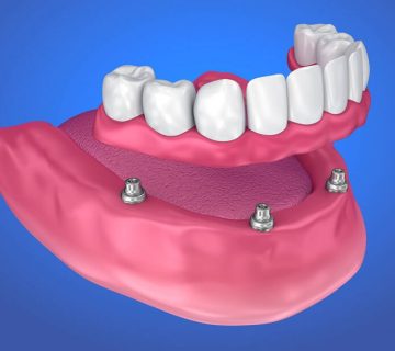 انتخاب پروتز دندان