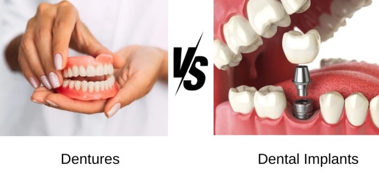طول عمر ایمپلنت در مقایسه با دندان مصنوعی