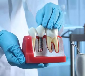 مزایا ایمپلنت دندان