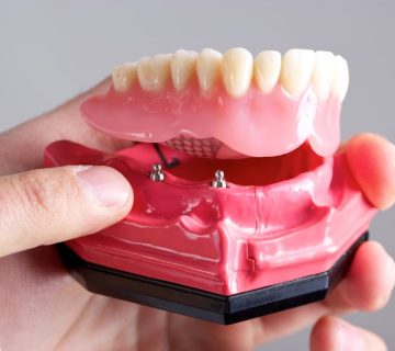 انتخاب بین ایمپلنت و دندان مصنوعی