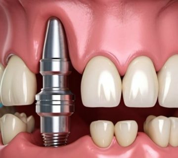 ایمپلنت دندان در کرج