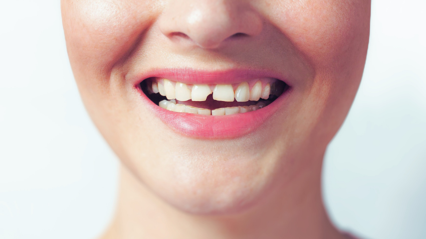 tooth fracture