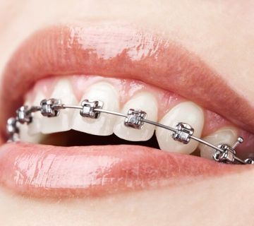 ارتودنسی ثابت