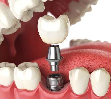 ایمپلنت تک دندان