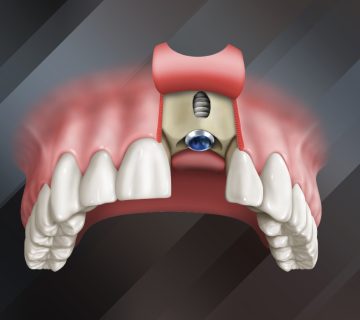 جراحی ایمپلنت فک بالا