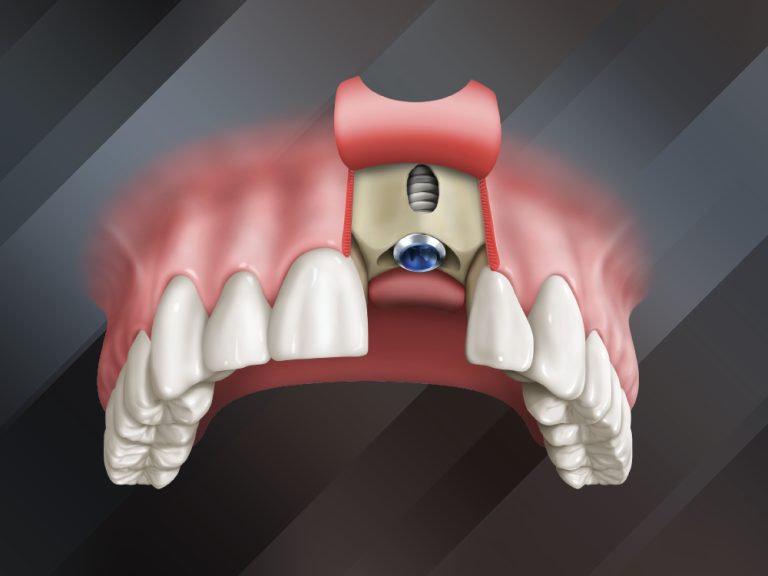 جراحی ایمپلنت فک بالا