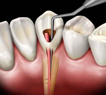 درمان خانگی ریشه دندان