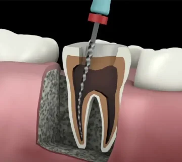 عصب‌کشی بعد از پولیش دندان