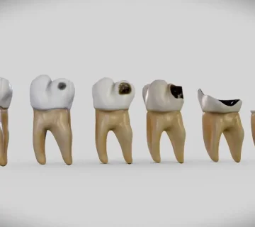 علت پوسیدگی دندان