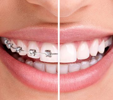 صاف کردن دندان بدون ارتودنسی