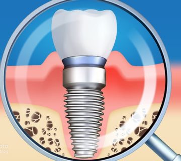 عفونت ایمپلنت دندان