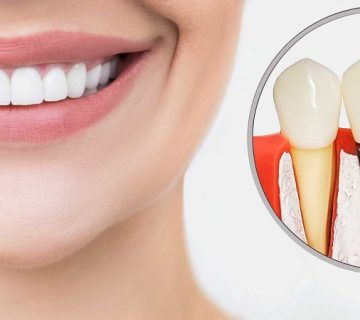 هزینه ایمپلنت دندان