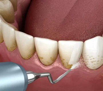 عوارض جرم گیری لثه
