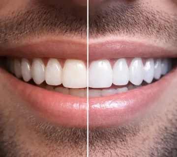 تفاوت لمینت و کامپوزیت و بلیچینگ