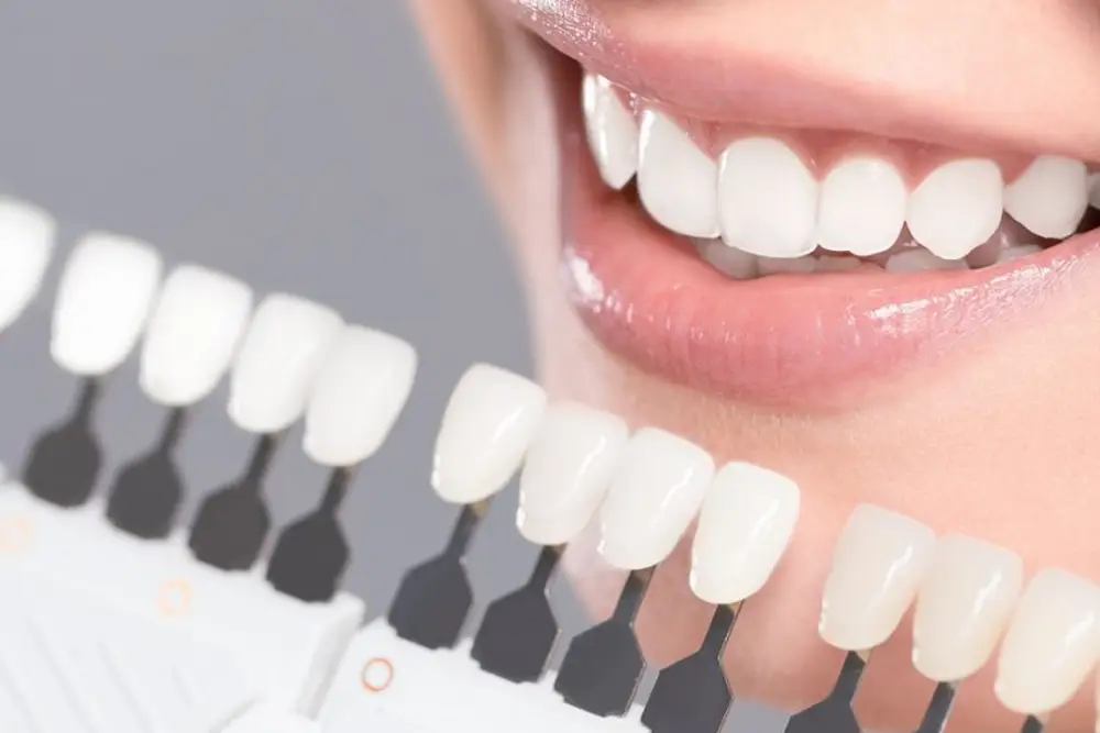 بررسی تفاوت لمینت و کامپوزیت و بلیچینگ
