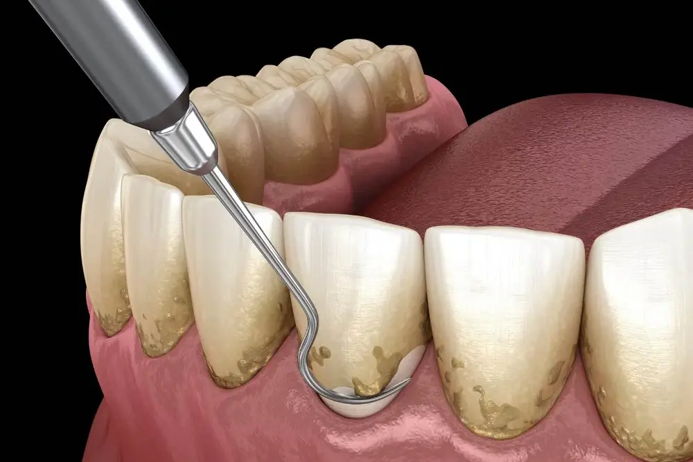 پلاکت دندان چیست؟