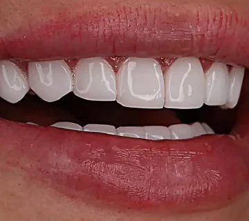 کامپوزیت لبه شیشه ای