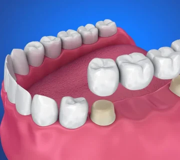 قیمت بریج دندان