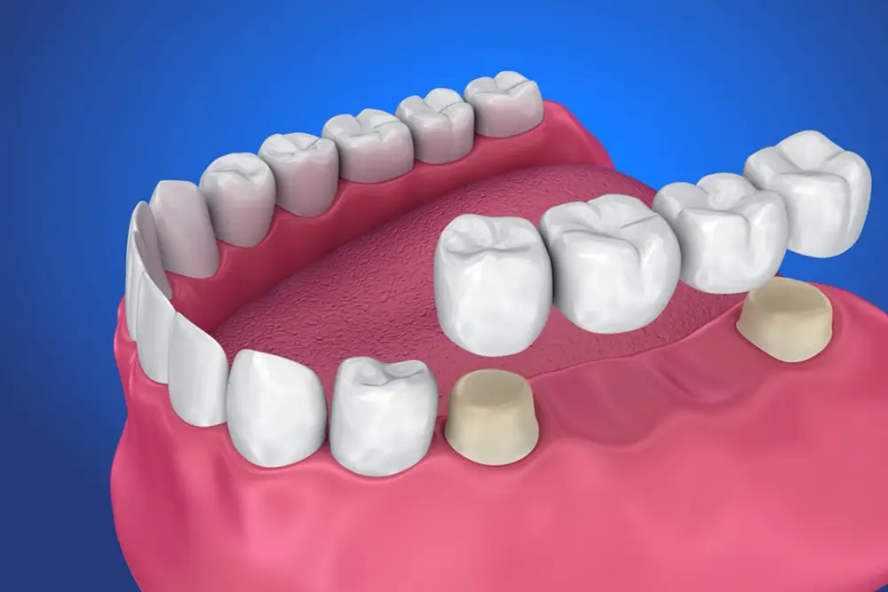 قیمت بریج دندان