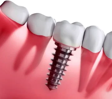 مرحله بعد از جراحی ایمپلنت