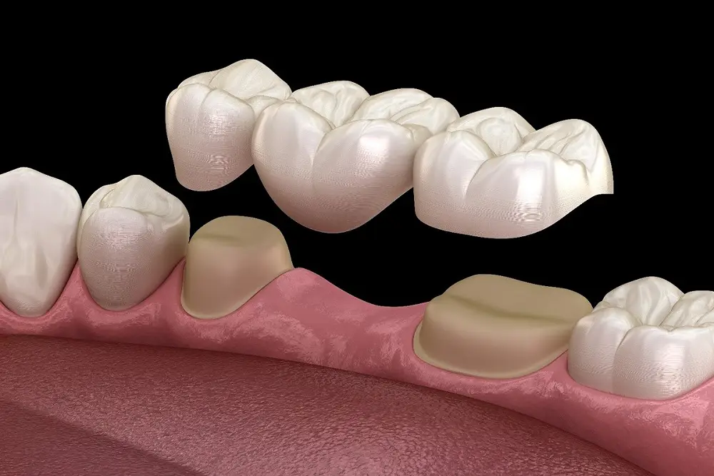 عکس بریج دندان جلو چیست؟